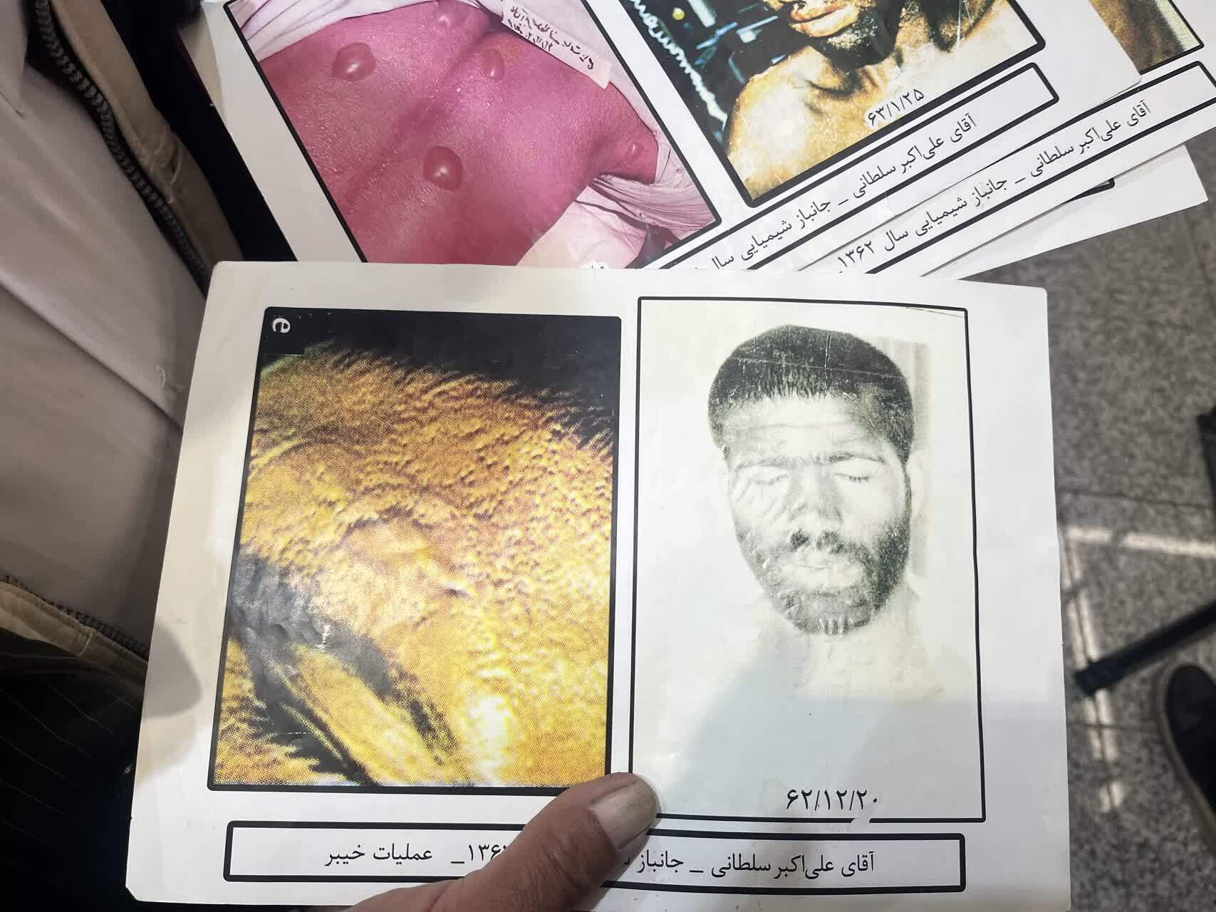 عکس‌هایی که زخم را فریاد می‌زدند؛ روایت جانبازی که در ۲۴سالگی پیر شد